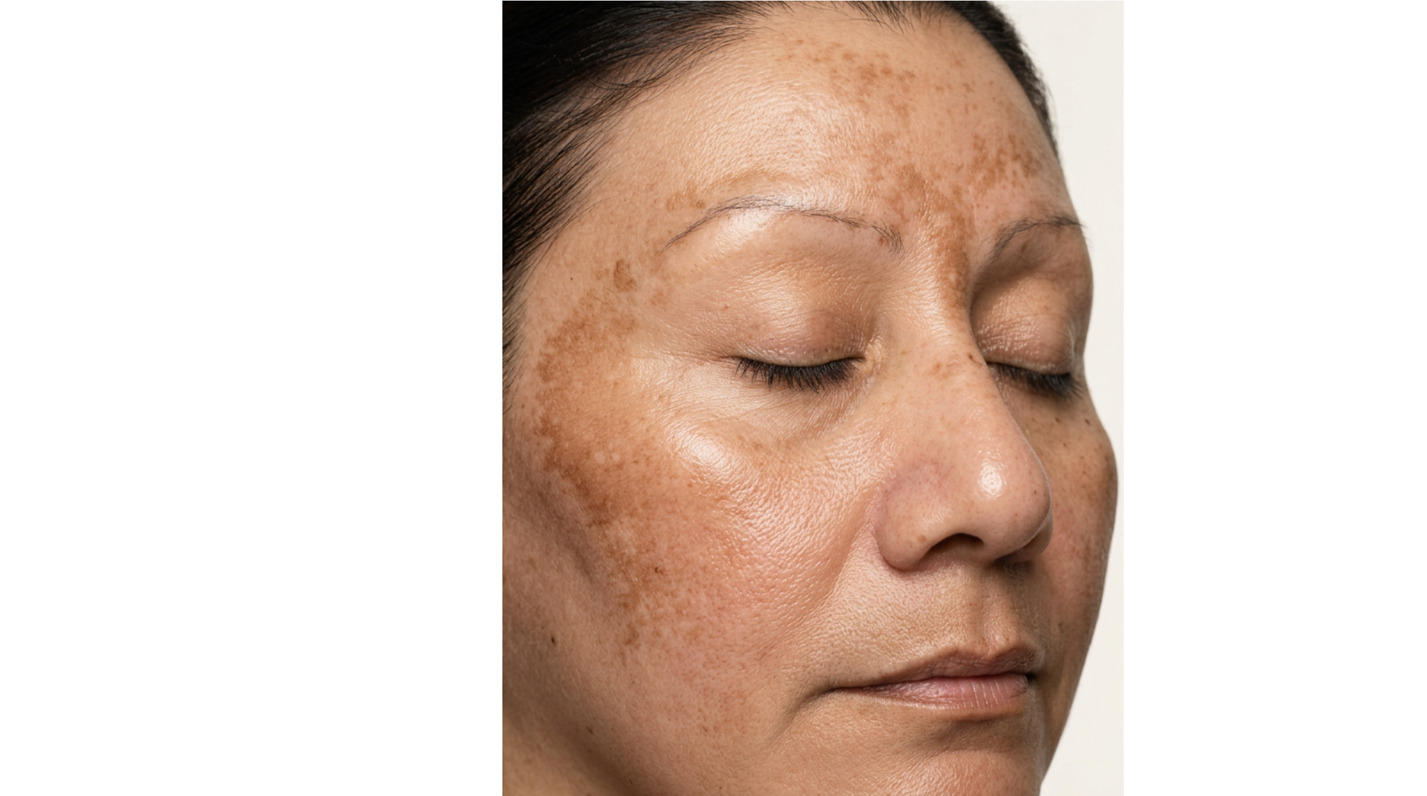 Melasma: Causes and Characteristics