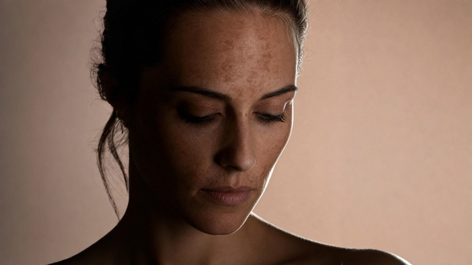 What Is Melasma? Everything You Need to Know About the “Mask of Pregnancy” (Even If You’ve Never Been Pregnant)